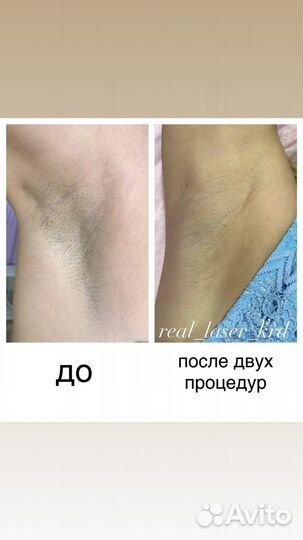 Лазерная эпиляция: глубокое бикини