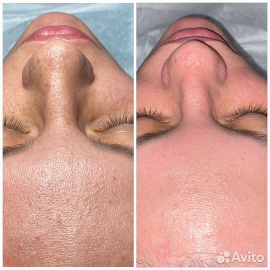 Атравматичная чистка лица