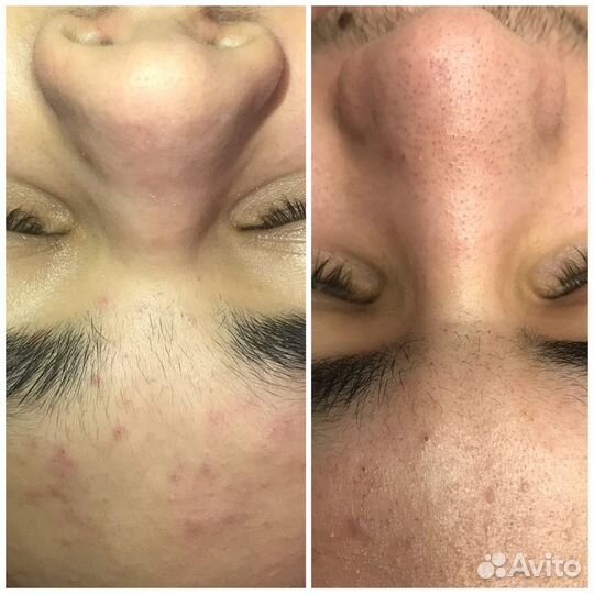 Чистка лица