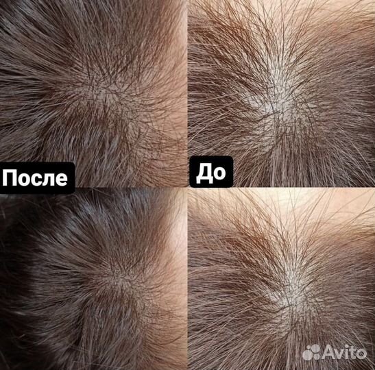 Трихопигментация, загущение волос