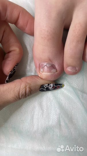 Педикюр, титановые нити, сложные стопы