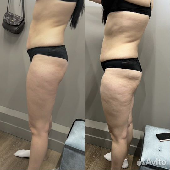 Lpg,коррекция фигуры