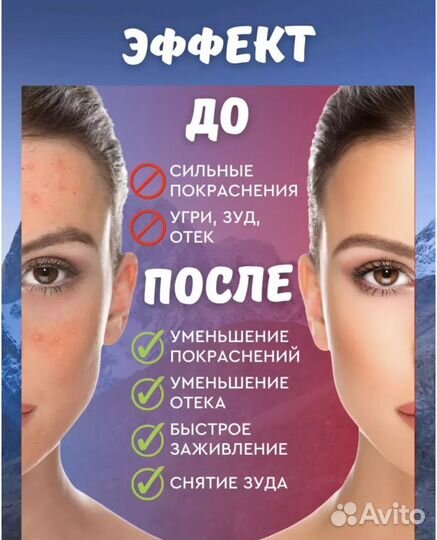 Мязь от акне