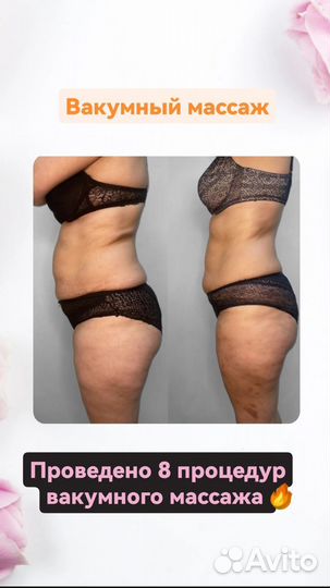 Аппаратный массаж