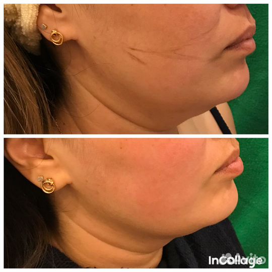 Массаж лица