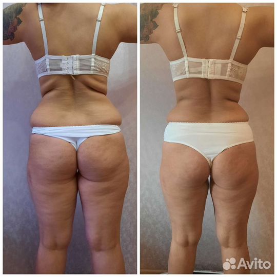 Массаж Аппаратный, Кавитация, RF-Лифтинг Вакуумный