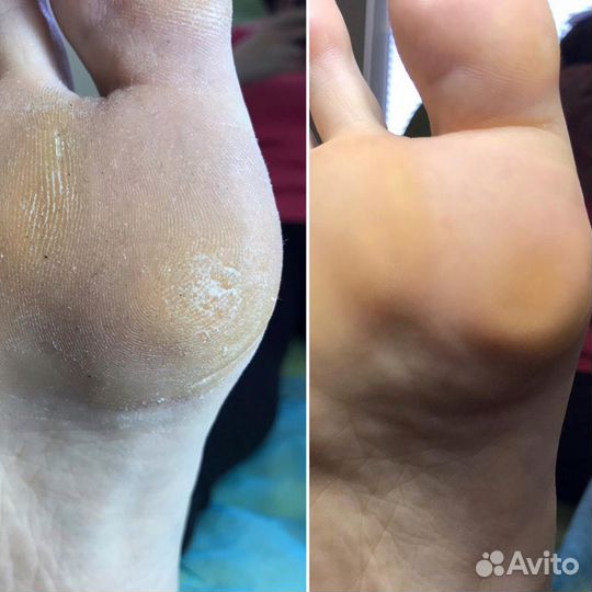 Педикюр подолог