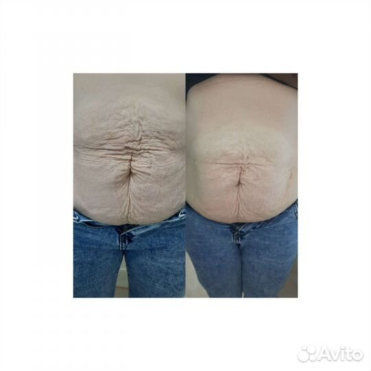 Криолиполиз