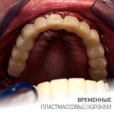 Стоматология зубные протезы