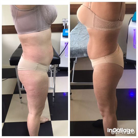 Массаж антицеллюлитный/lpg/кавитация/RF лифтинг