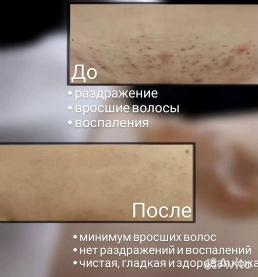 Лазерная эпиляция