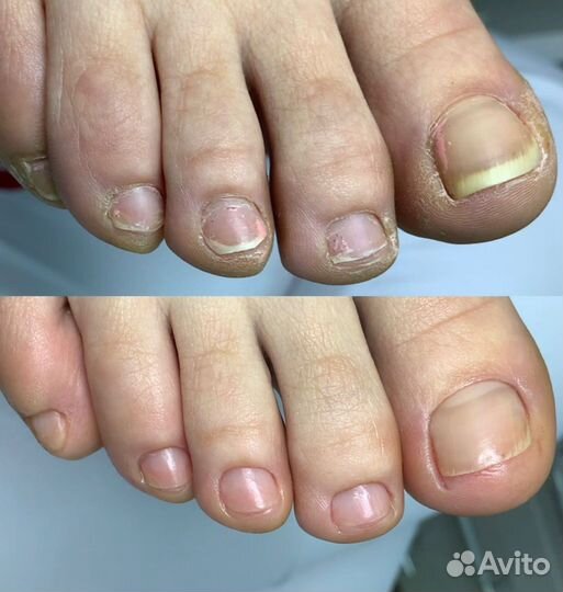 Медицинский педикюр подолог