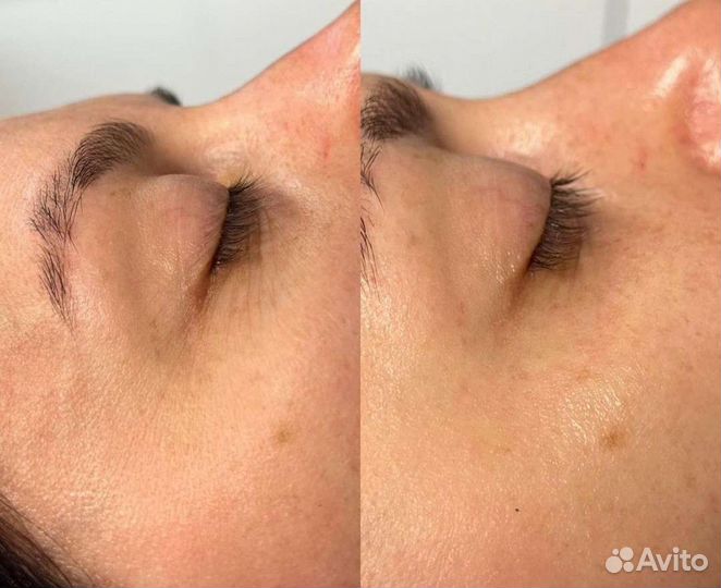 Пилинг LET для глаз и губ