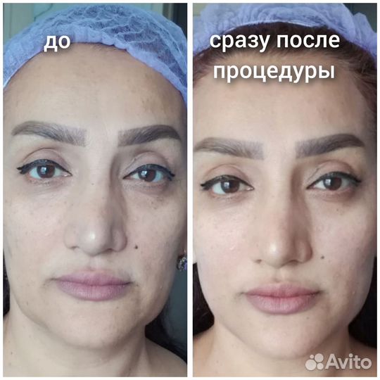 Морщин нет. Подтяну овал,веки. Смас-лифтинг
