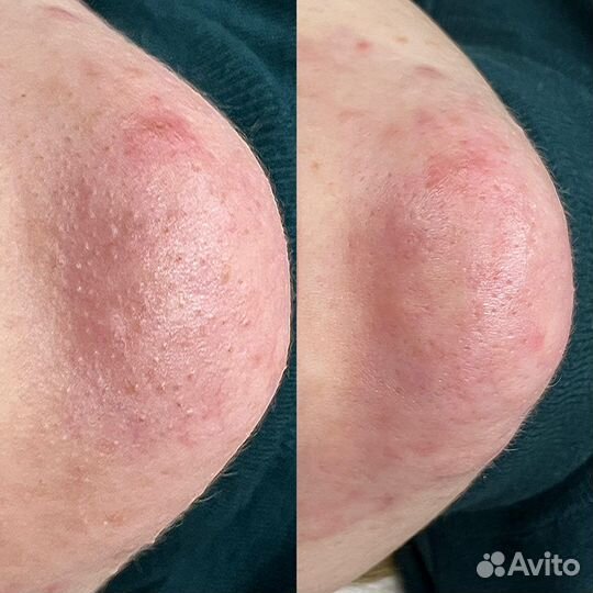 Чистка лица