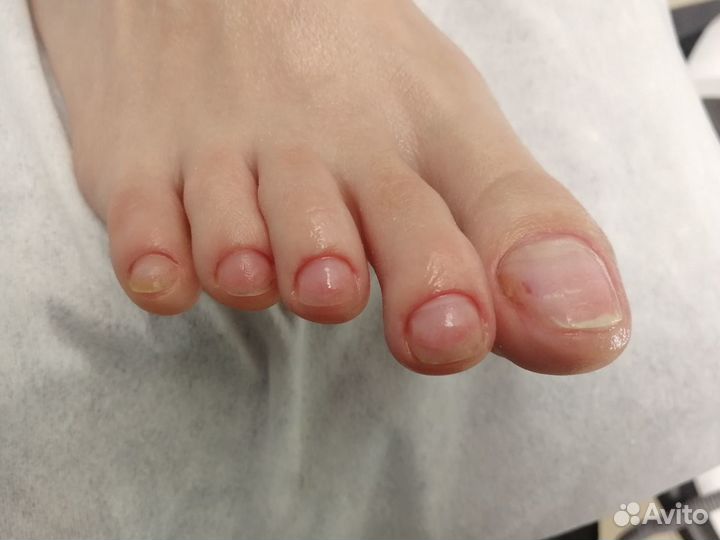 Аппаратный педикюр