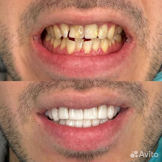 Композитные виниры