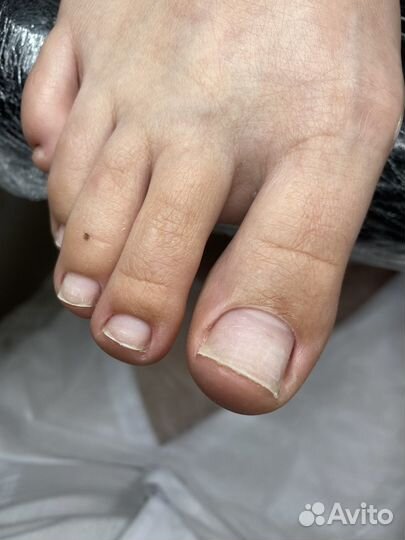 Вросший ноготь, грибок. педикюр