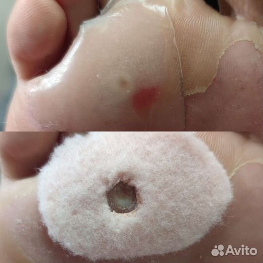 Лечебный педикюр