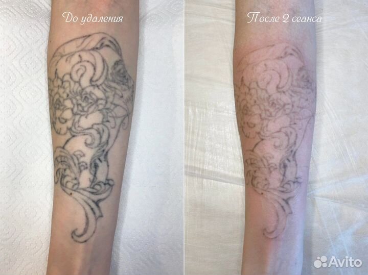 Удаление Татуажа и Тату без Шрамов и Ожогов