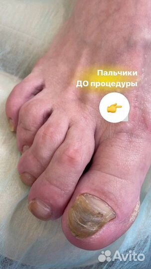 Педикюр Подология Бесплатно консультация