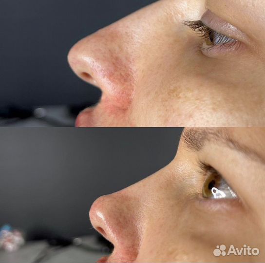 Коррекция формы носа, ринопластика без операции