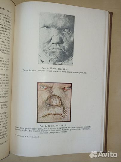 Верхние дыхательные пути и орган слуха при проказе