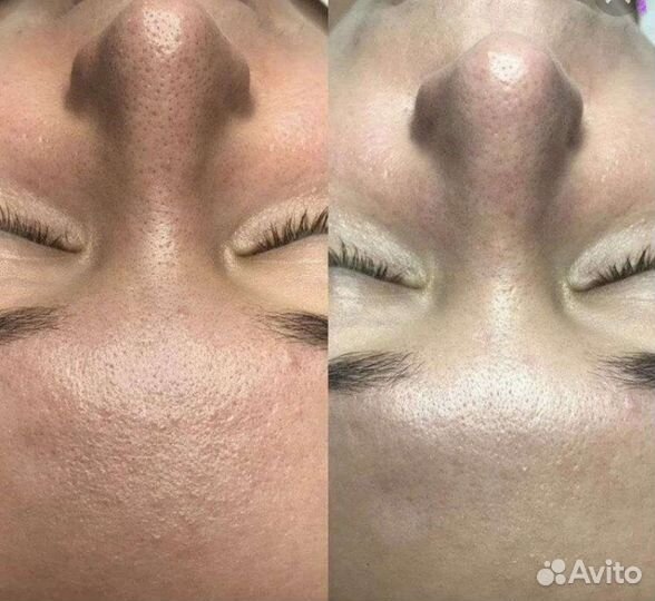 Нанесение маски по типу кожи