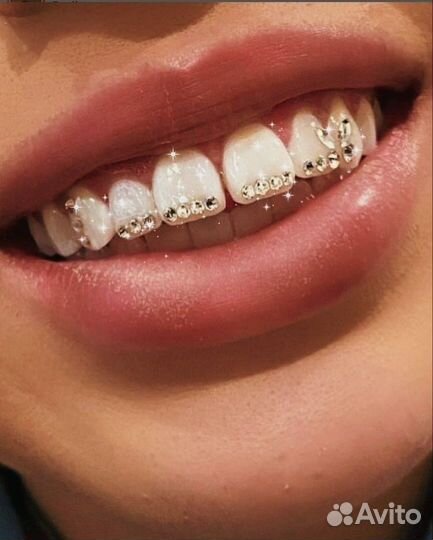 Скайсы на зубы/ установка страз Swarovski