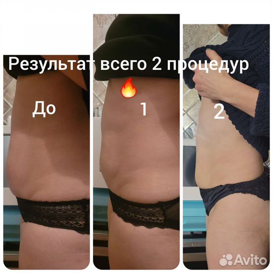 Еmsculpt прокачка мышц, похудение