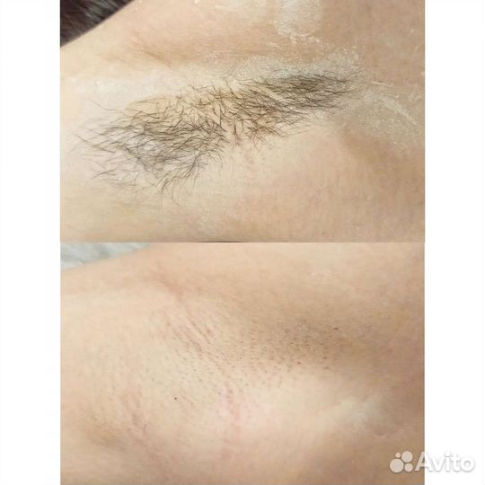 Шугаринг на дому