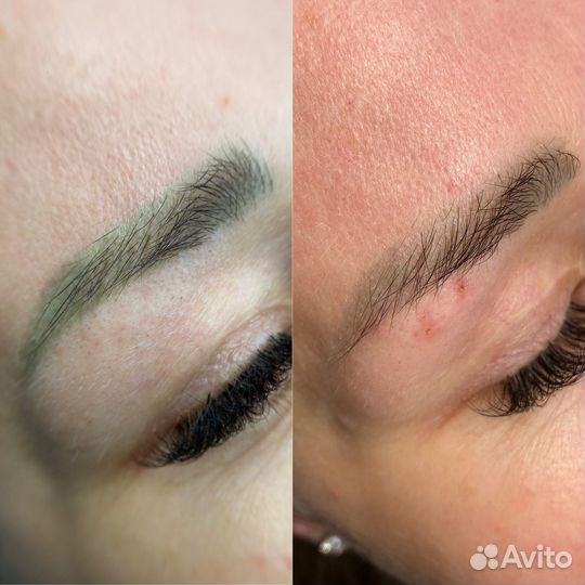 Удаление татуажа