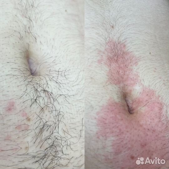Электроэпиляция