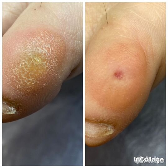 Удаление мозолей, бородавок, подолог