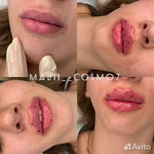 Увеличение губ /обучающие / курсы косметолог