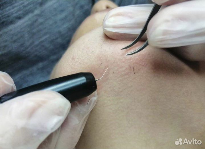 Электроэпиляция Депиляция