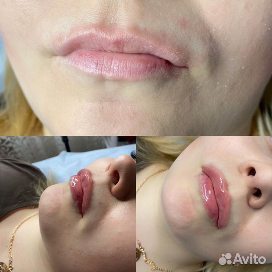 Увеличение губ