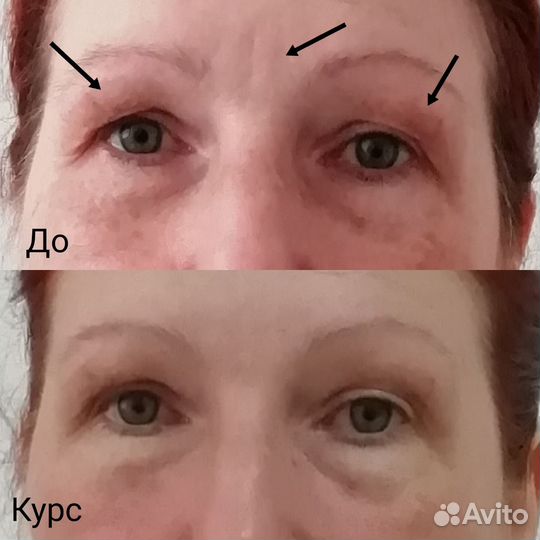 Витапластика