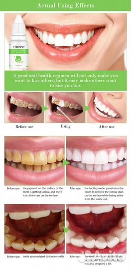 Отбеливание зубов в домашних условиях