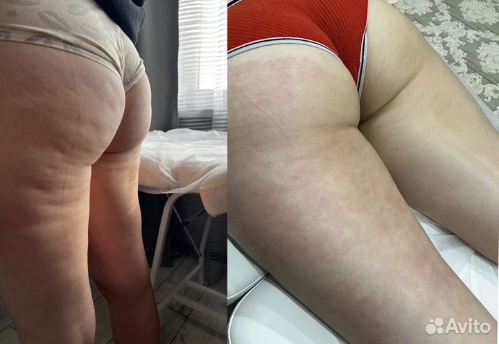 Аппаратный массаж