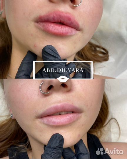 Увеличения губ/ косметолог