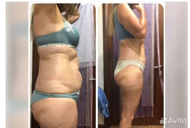 Липосакция без операции в Ростове на Дону