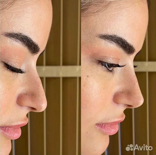 Губы, Ботокс. Full Face Требуются модели