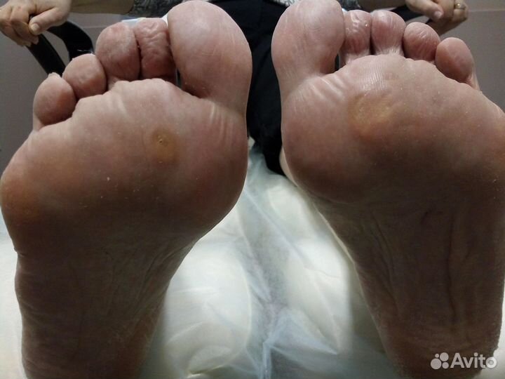 Лечебный педикюр