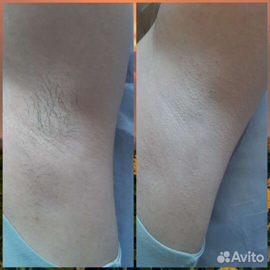 Шугаринг Фитоэпиляция