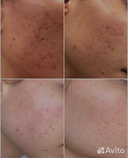 Биоревитализация