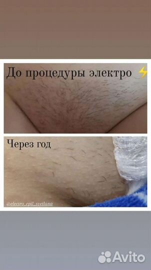 Электроэпиляция г. Буинск