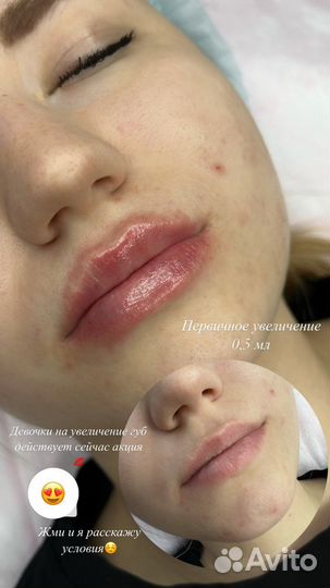 Увеличение губ, ботокс