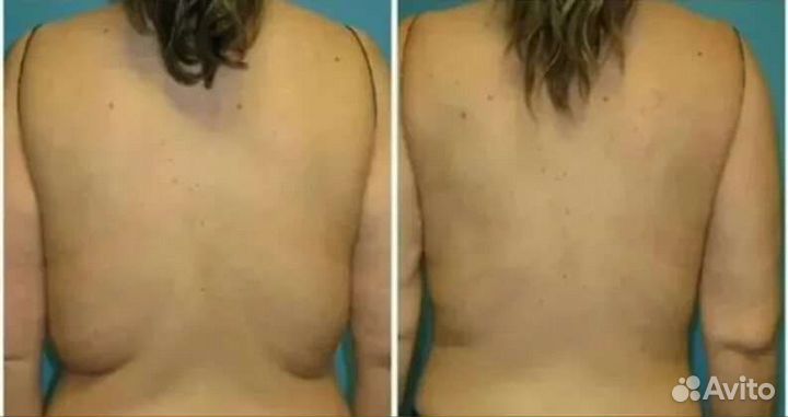 Липосоникс