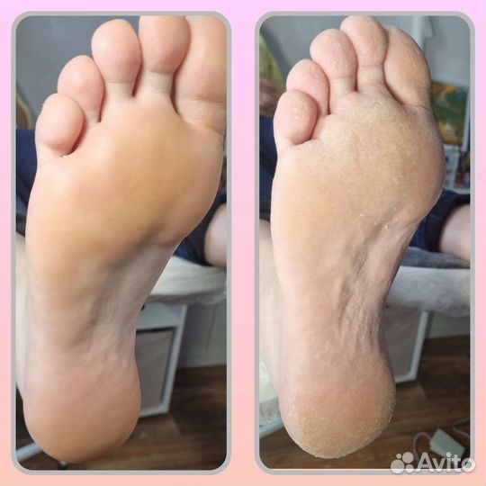 Педикюр, подолог